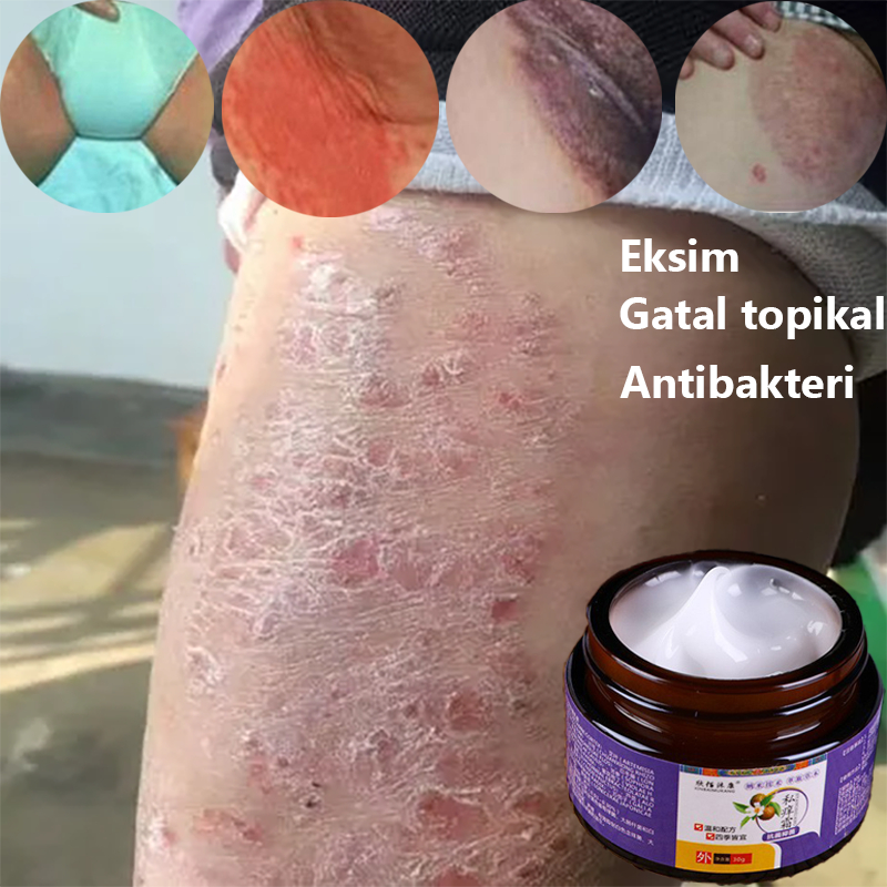 Obat Gatal Selangkangan Salep Gatal Paling Ampuh Anti Jamur Obat Selangkangan Gatal Dan Hitam Obat G