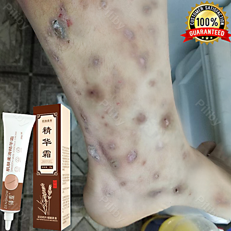 Salep penghilang bekas luka hitam Penghilang bekas luka di kaki Menghilangkan bekas luka di wajah kr