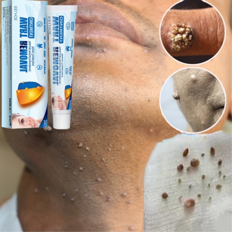 Salep kutil paling ampuh Penghilang kutil Skin tag remover Penghilang kutil di wajah Wart removal Sa