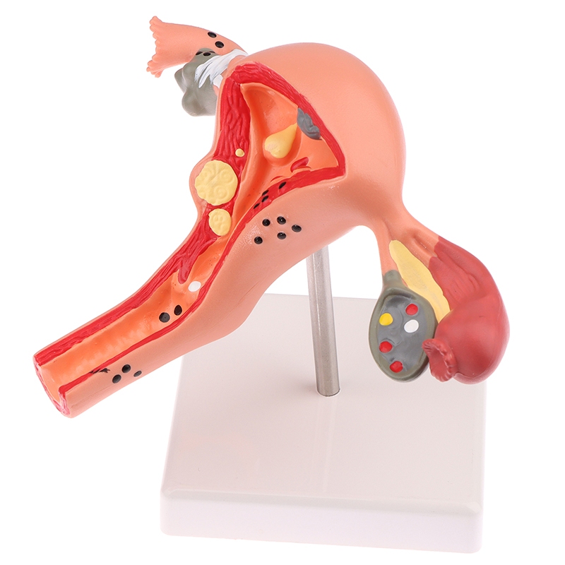 Uterus Ovary Anatomical Model Anatomy Alat Peraga Anatomi Model Patologis Uterus Ovarium Manekin Rah
