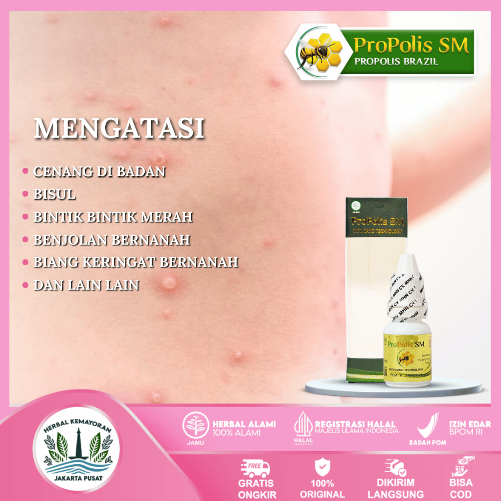 

Obat Cenang, Bisul Telur Kodok, Benjolan Bernanah - Propolis SM 100% ASLI Herbal Terlaris Aman