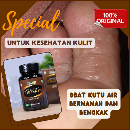 Obat kutu air bernanah dan bengkak, Penghilang kutu air di sela jari kaki, jamur di sela-sela jari k