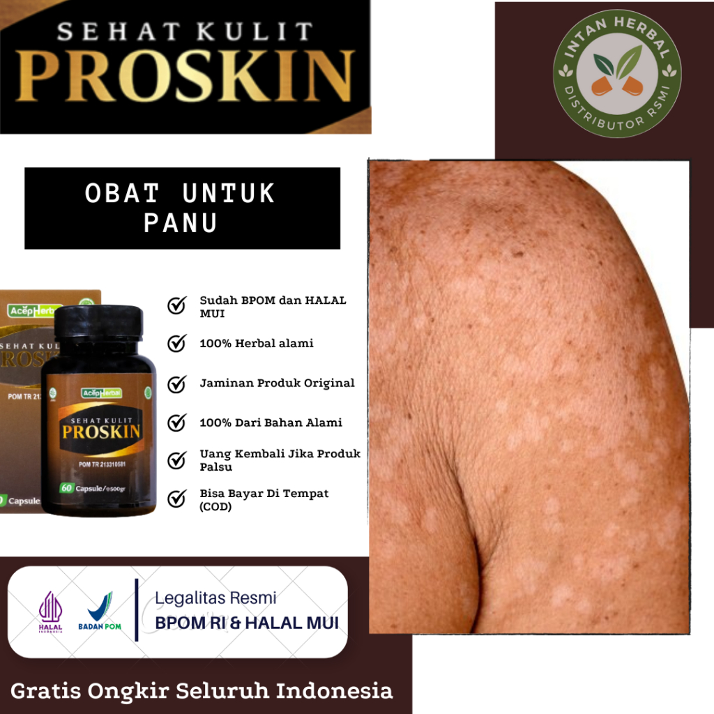 Obat Panu, Panu Di Wajah Punggung, Jamur Kulit Panu, Panu Kadas Kudis, Panu Anak & Dewasa, Penghilan