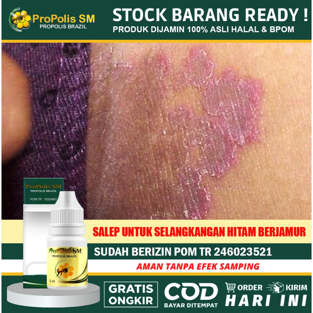 Obat Selangkangan Pemutih Selangkangan Hitam Obat Kurap Selangkangan - Propolis SM