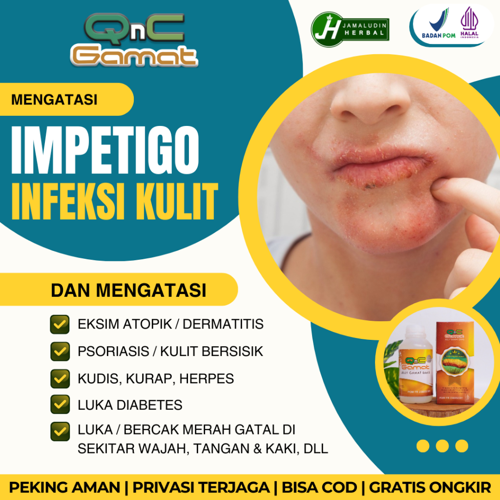 Salep Oles Untuk Mengobati Impetigo. Obat Infeksi Kulit Melepuh, Bercak Merah Di Tangan. Kaki. Wajah