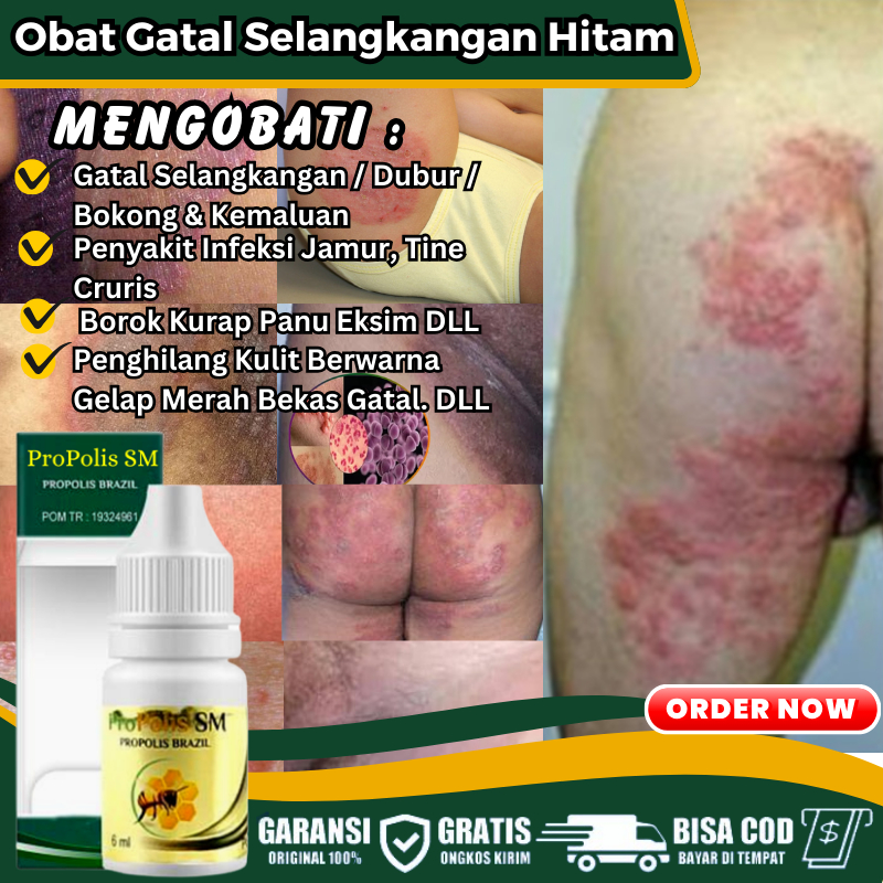 Obat Gatal Bruntusan Bernanah di Kulit Selangkangan, Salep Atasi Psoriasis Kulit Kering Lecet Berjam