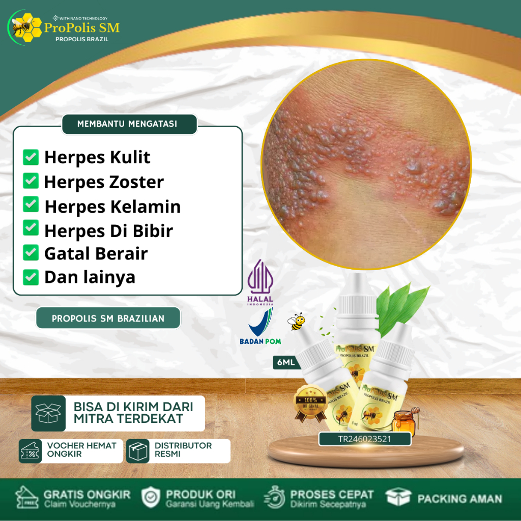 Obat Herpes Kulit, Obat Herpes Zoster, Obat Herpes Genital / Herpes Kelamin, Obat Herpes Di Bibir, S