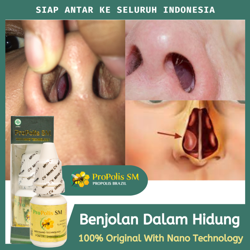 PROPOLIS SM | Obat Benjolan Dalam Hidung, Obat Benjolan Di Tulang Hidung, Obat Polip Hidung