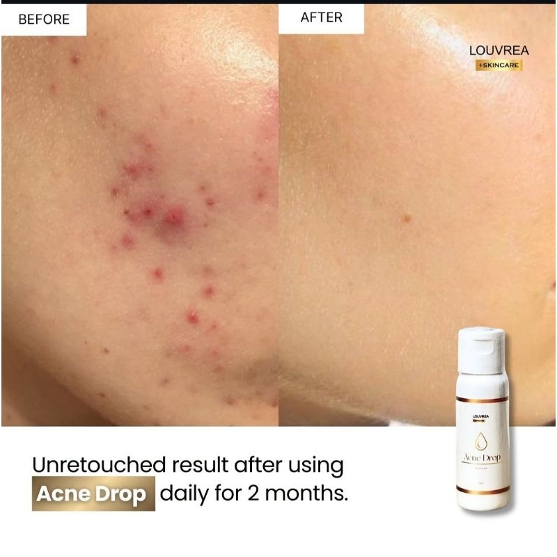 Louvrea Acne Drop/L'ouvrea obat jerawat/obat totol/obat bruntus