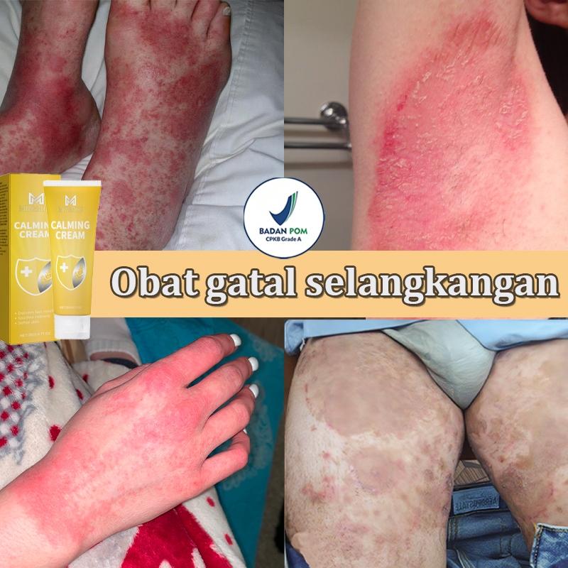 Salap gatal kulit yang ampuh Obat gatal selangkangan Obat gatal gatal Salep gatal selangkangan 20ml 