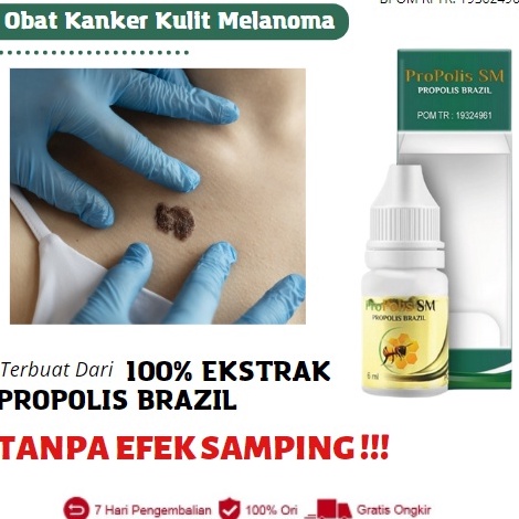 Promo Merakyat Obat Kanker Kulit Salep Kanker Kulit Melanoma Karsinoma Sel Basal Karsinoma Sel Skuam