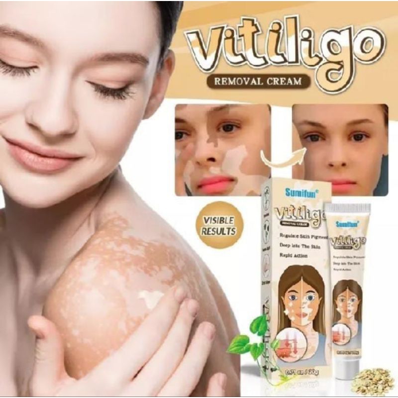 VITILIGO Cream krim penghilang vitiligo bercak putih noda putih pada kulit pigmen bintik belang mela