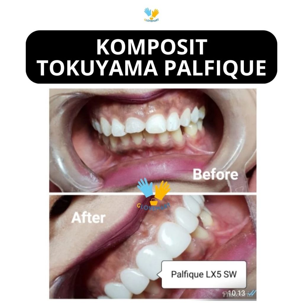 Komposit Tokuyama Palfique LX 5 / Composite Tokuyama Palfique LX 5 / Komposit Tokuyama RB7