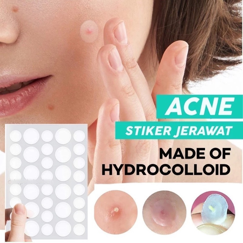 Stiker Jerawat Acne Hydrocolloid