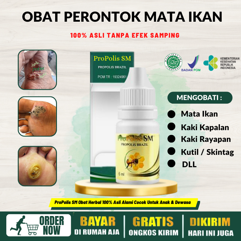Obat Mata Ikan di Telapak Kaki / Tangan, Obat Clavus, Obat Penghilang Mata Ikan Menahun, Obat Mata I