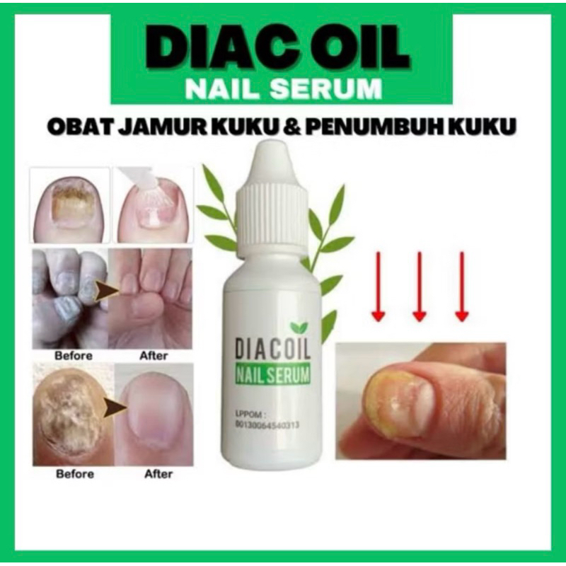 Diacoil Nail Serum Obat Jamur Kuku & Penumbuh - Kuku centengan rusak bengkak penghilang jamur kuku