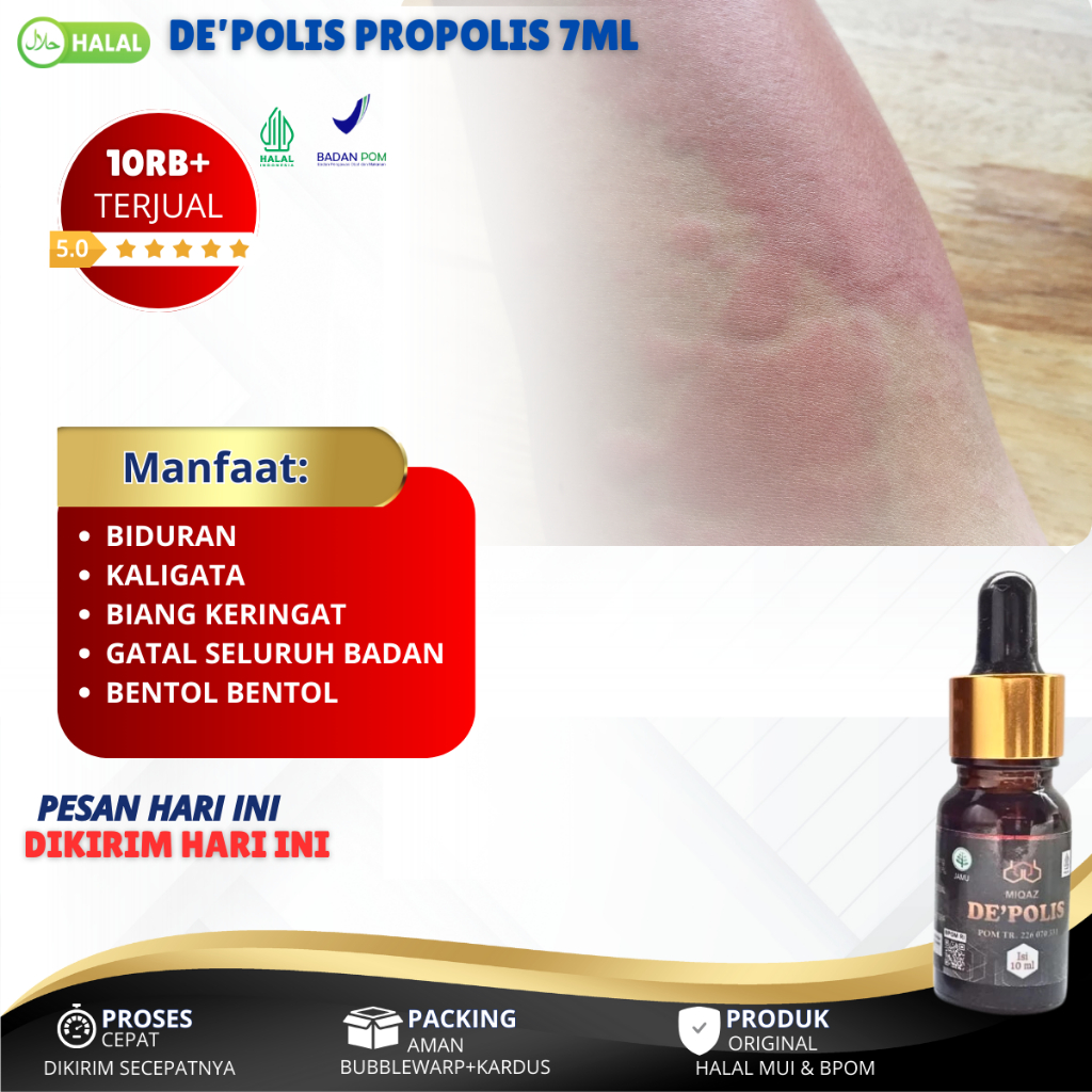 Obat Biang Keringat, Biang Keringat Anak, Biang Keringat Dewasa, Biang Keringat Bayi, Biang Keringat