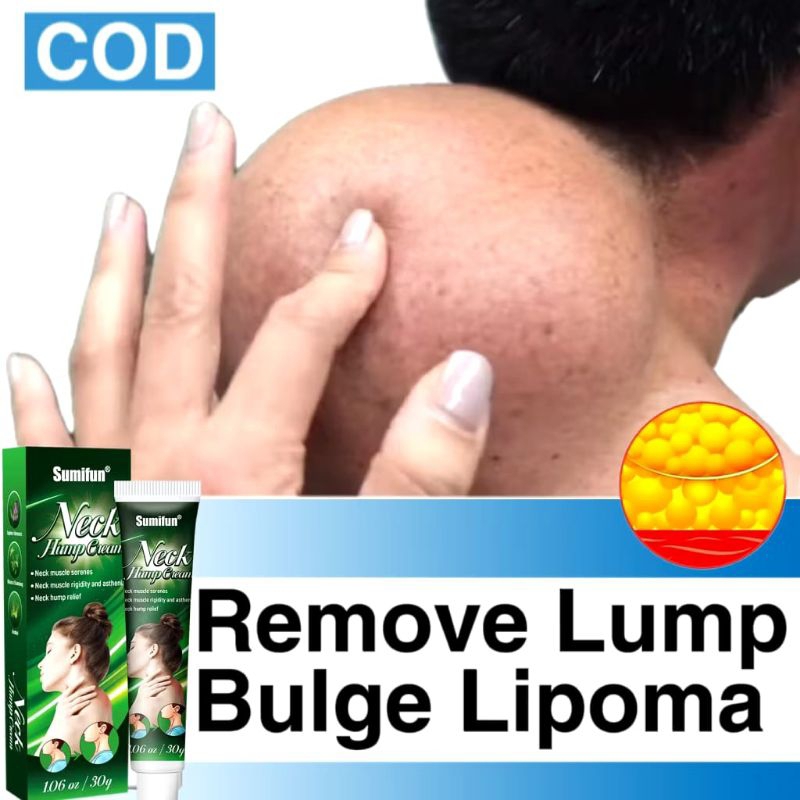 sumifun lipoma benjolan leher neck cream lipoma