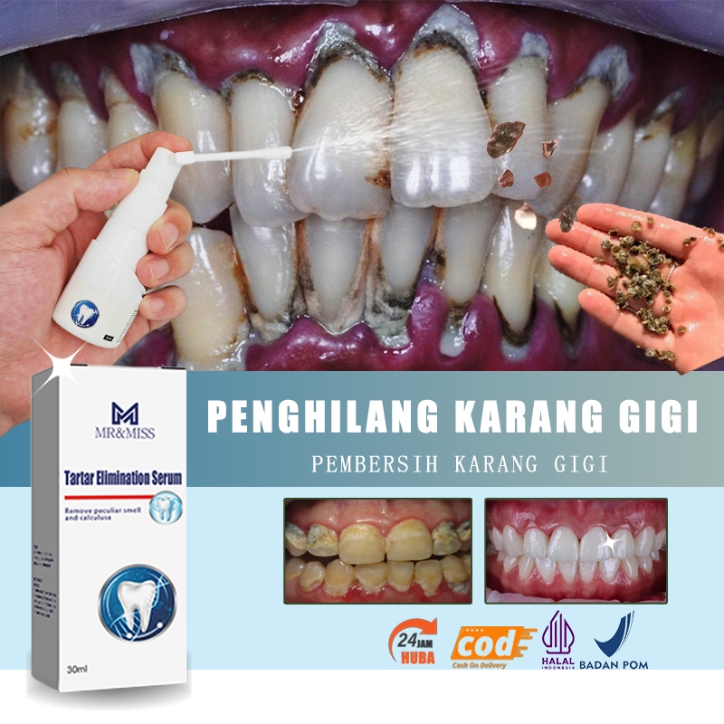 Perontok karang gigi paling ampuh Pembersih karang gigi Penghilang karang gigi 30ml Perontok karang 