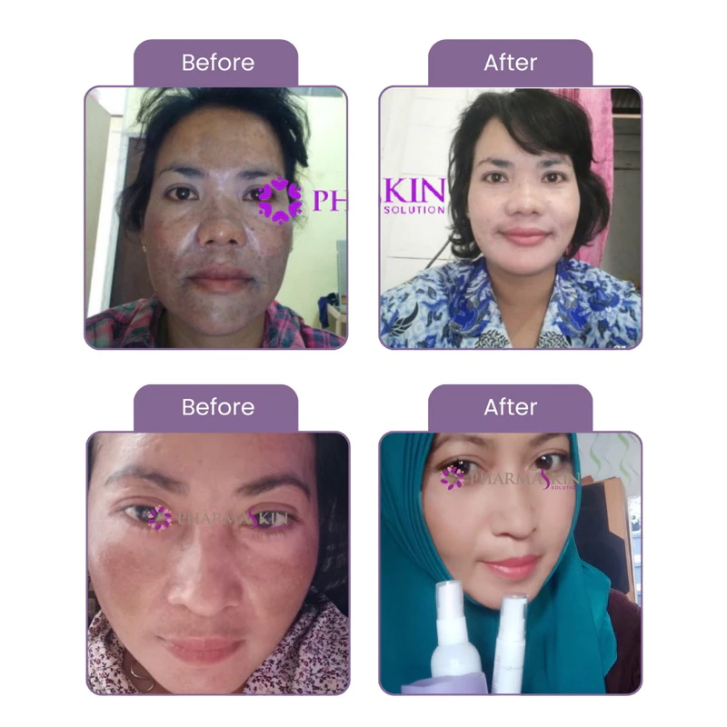 【BPOM】Cream flek hitam membandel By Pharmaskin Paket Whitening Flek Series krim penghilang flek hita