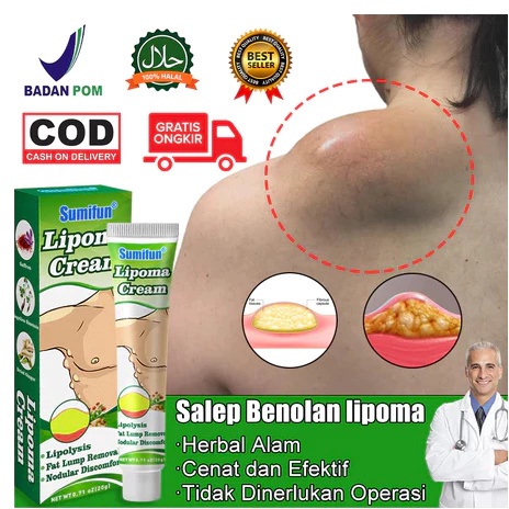 Krim Lipoma Obat Tumor Liposarkoma Krim Pengobatan Tumor Lipoma 20g Leher Tangan Ketiak Benjolan Leh