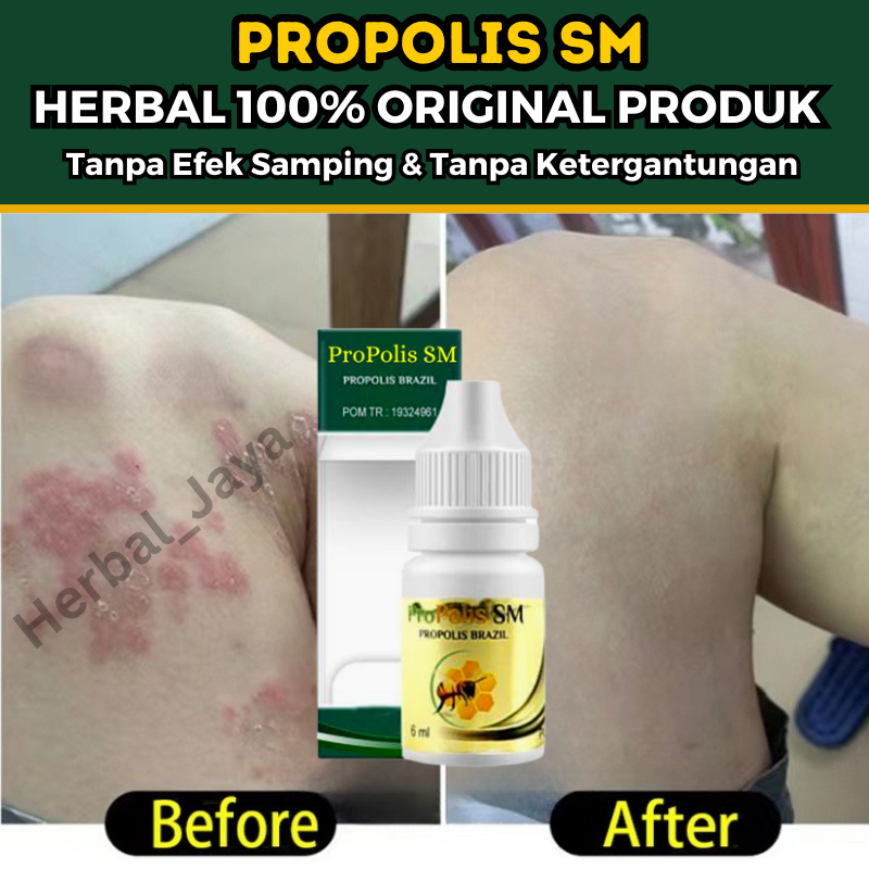 Salep Bruntusan di Kulit, Salep Penghilang Ruam Merah / Bintik Bintik Merah, Obat Penghilang Gatal &