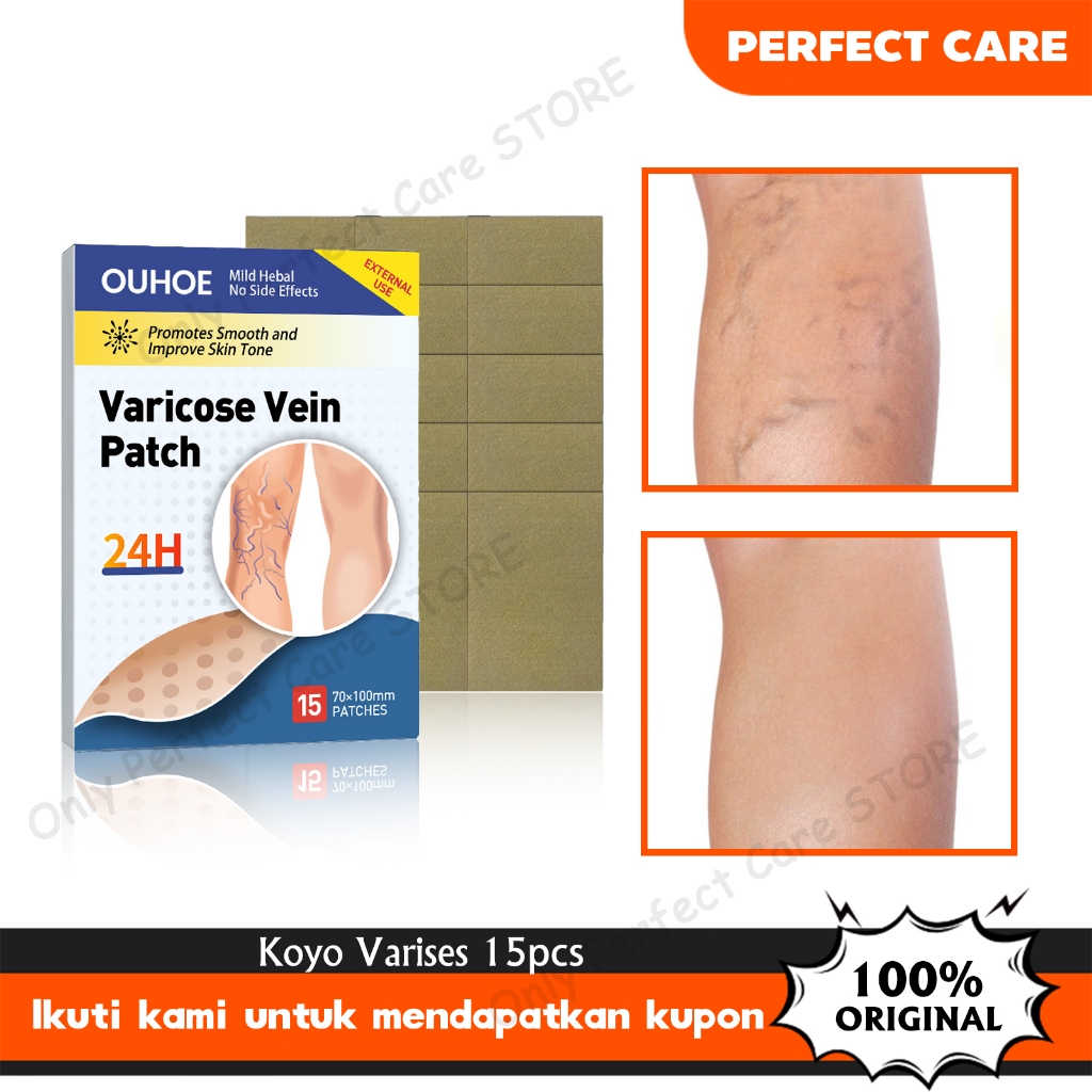 OUHOE 15pcs Koyo Varises Penghilang Varises Di Kaki Varicose Patch Obat Varises Herbal Koyo Varicose