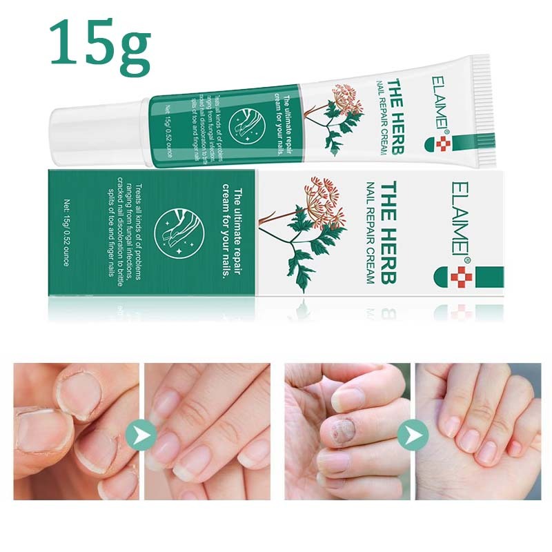 15g Obat Jamur Kuku Kaki Salep Jamur Kuku Kaki Penghilang Jamur Kuku Jamur Dan Rusak Perawatan Kuku