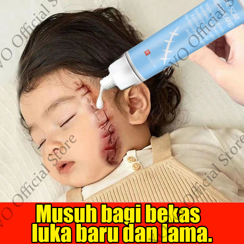 penghilang bekas luka ampuh Penghilang bekas luka Acne Cream Scar Removal Penghilang Noda Bekas Jera