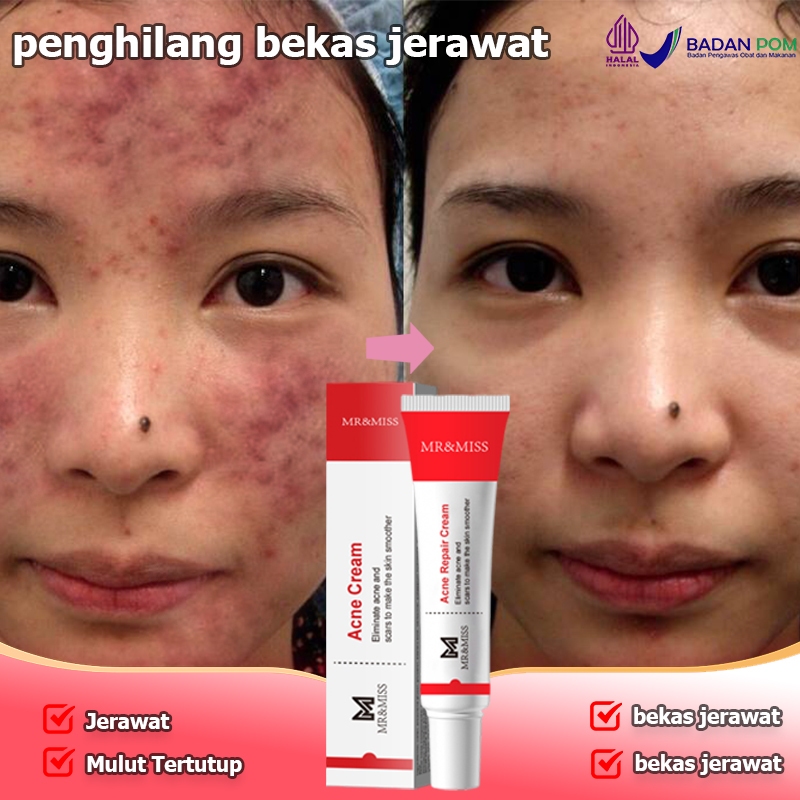 Obat totol jerawat Salep jerawat Menghilangkan bekas jerawat Penghilang bekas jerawat Obat jerawat 2