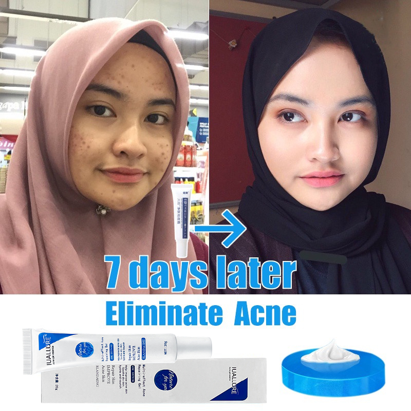 Krim Jerawat Acne spot gel Acnes sealing gel 20G IUALLURE PENGHILANG JERAWAT acne cream jerawat para