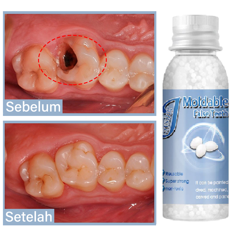 lem gigi palsu permanen penambal gigi Palsu Gigi Temporary Butir Penambal Gigi bahan gusi gigi palsu