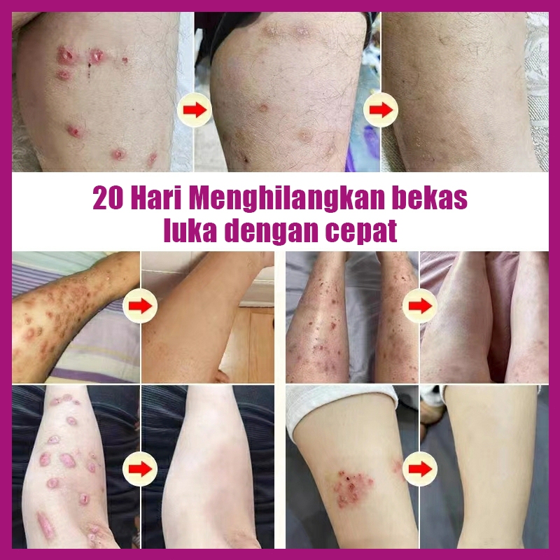 Penghilang bekas luka hitam koreng salep penghilang bekas luka hitam salep keloid paling ampuh 20ml