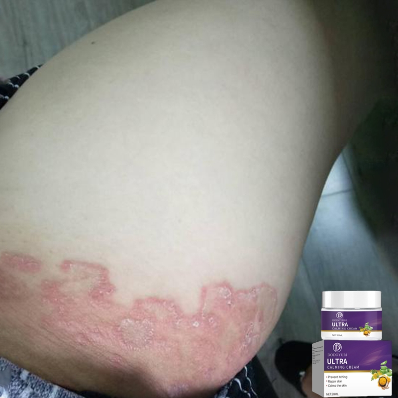 Obat gatal selangkangan obat kurap salep gatal china paling ampuh salep gatal jamur selangkangan 20m