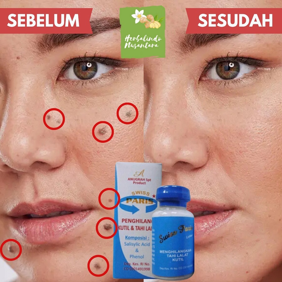 Penghilang Kutil Dan Tahi Lalat Obat Salep Penghilang Kutil Di Wajah Papiloma Wajah Kutil Leher