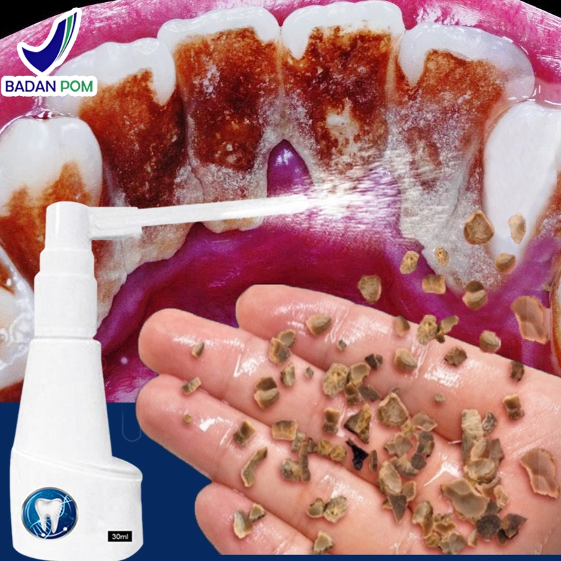 Perontok karang gigi paling ampuh Penghilang karang gigi Pembersih karang gigi berkerak 30ml alat pe