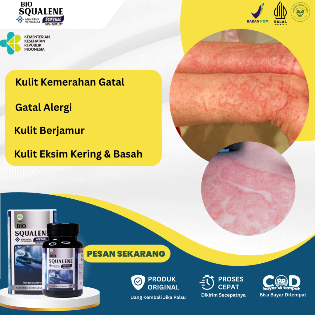 Obat Kulit Gatal, obat Kulit Kerng Dan Gatal, Obat Gatal Jamur Kurap, Obat Eksim Kering Dan Basah, O