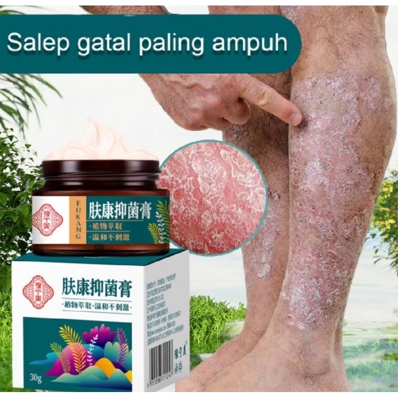 Original Salep gatal cina paling ampuh / salep gatal kutil 30g