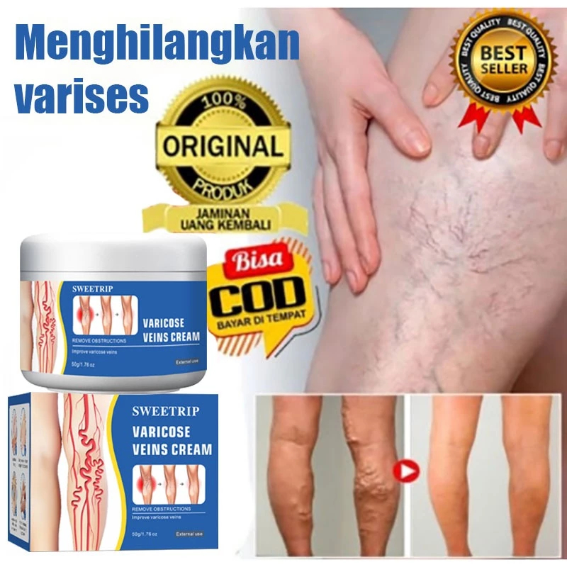 Varicose Veins Cream Obat Varises Salep Penghilang Varises Paling Ampuh Obat Varises Kaki Flebitis