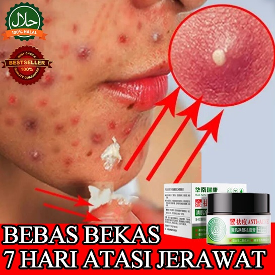 Penghilang jerawat cream penghilang bekas jerawat penghilang bekas jerawat menghilangkan jerawat  me