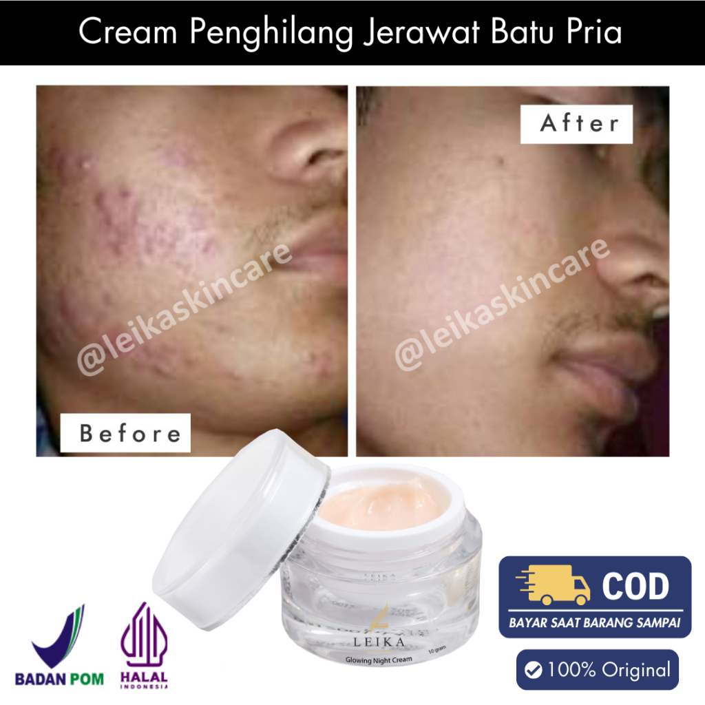 Cream Jerawat Penghilang Jerawat Batu Penghilang Jerawat Dan Bekas Jerawat Penghilang Jerawat Dan Br