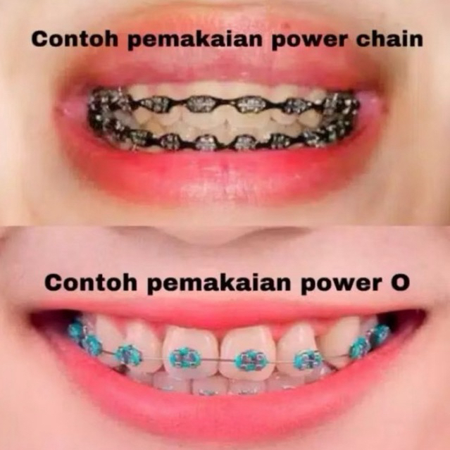 

behel gigi dan karet variasi ready bjm