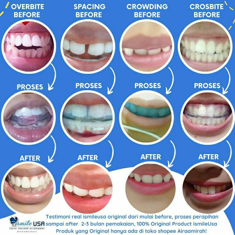 Perapi Gigi - Teeth Trainer Allignment -garansi 100% ismileUSA orthodentic Retainer - Behel Kawat Gi