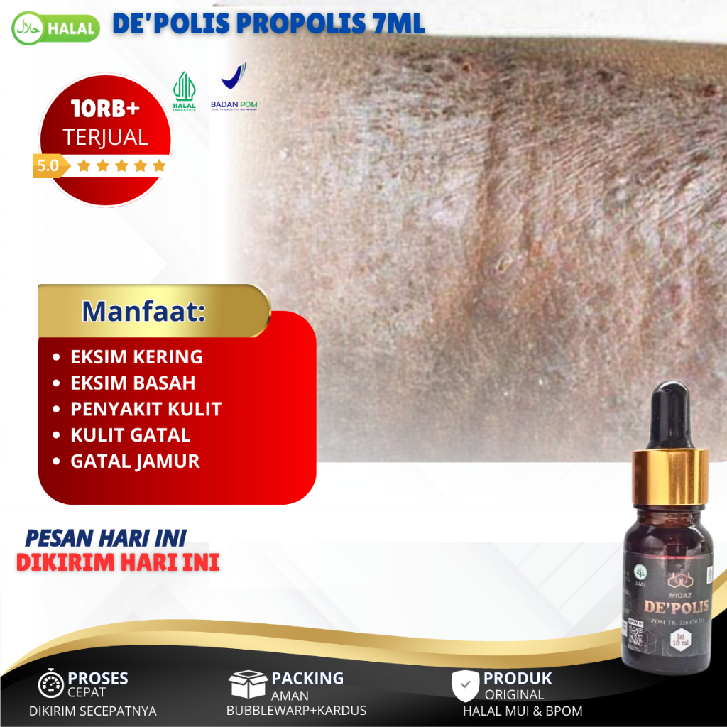 Obat Eksim Basah, Eksim Kering, Gatal-Gatal Eksim, Eksim Kering Menahun, Eksim Menahun, Eksim Kering