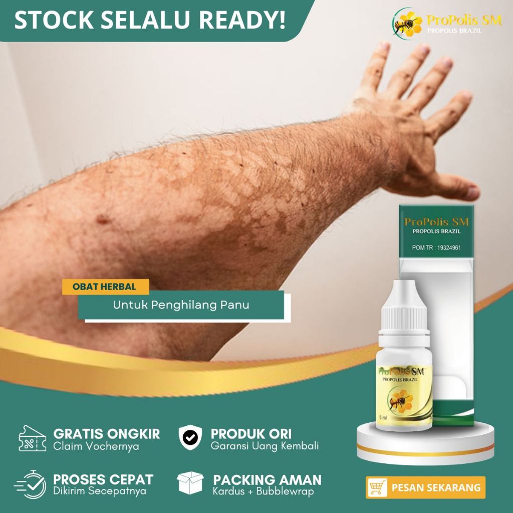 Obat Panu, Obat Panu Pada Kulit, Obat Penghilang Panu, Obat Menghilangkan Panu, Obat Hapur Kulit