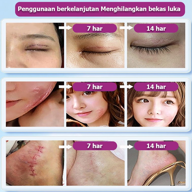 Salep penghilang bekas luka Penghilang bekas luka hitam koreng Obat penghilang bekas luka Bio herbal