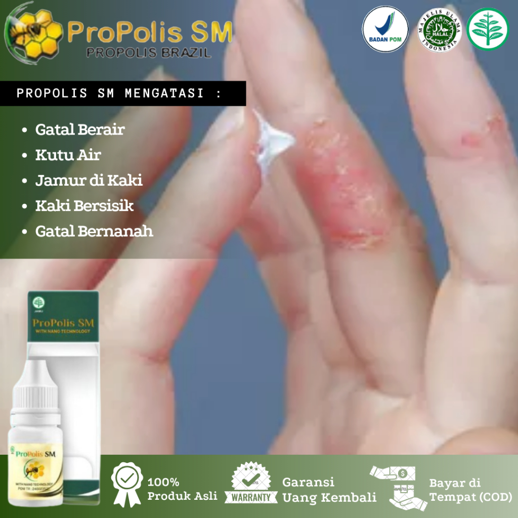 Propolis SM - Obat Gatal Berair, Gatal Kutu Air di Sela Jari Tangan, Gatal Berair di Kaki, Gata Kuli