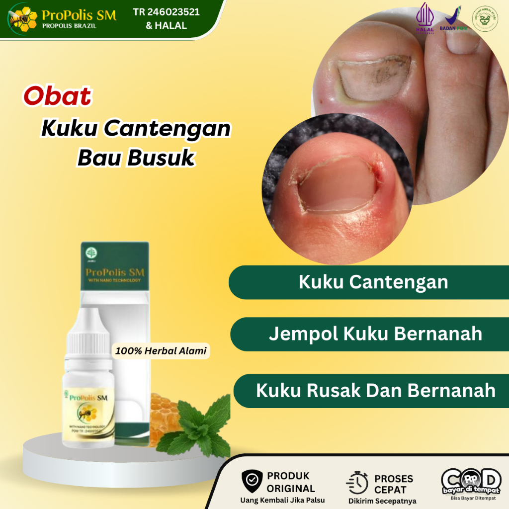 Obat Kuku Cantengan, Kuku Rusak, Jempol Kuku Kaki Bernanah Dan Bau, Psoriasis Kuku Kaki, Kuku Rusak 