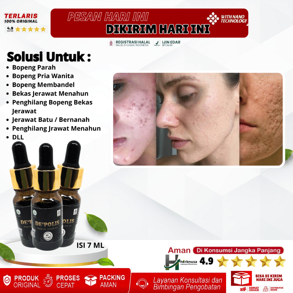 Obat Bopeng Parah, Bopeng Menahun, Bopeng Pria Wanita, Bopeng Membandel, Bekas Jerawat Menahun, Obat