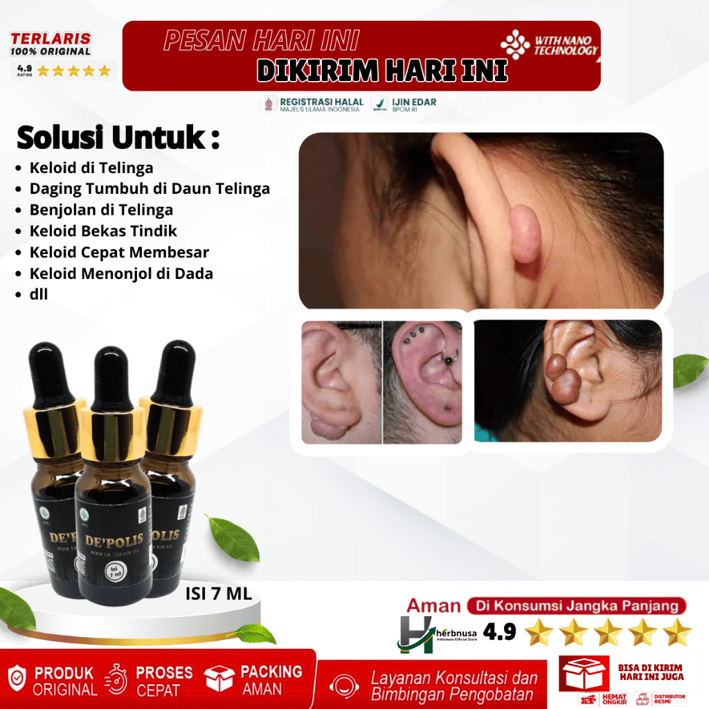 Obat Keloid di Telinga, Penghilang Daging Tumbuh di Daun Telinga, Obat Benjolan di Telinga, Salep Ke
